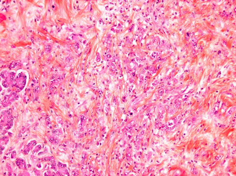 A light micrograph showing the pink and purple fibrous tissue of pancreatic cancer