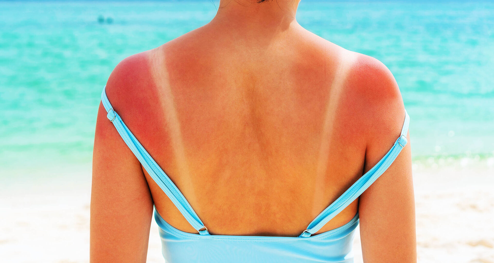 Main cause of sunburn is identified, it's time to rewrite the textbooks