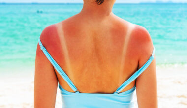 Main cause of sunburn is identified, it's time to rewrite the textbooks
