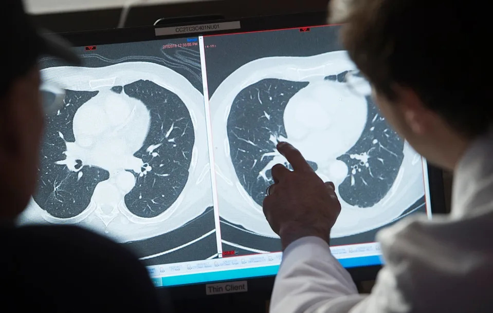 The drug amivantamab has been found to be effective at shrinking or eliminating tumors for certain types of cancer in an 11-nation clinical trial (AFP/Getty)
