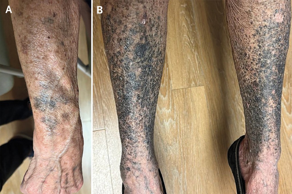 Collage of a patient's forearms and legs with confluent erythematous papules and plaques.