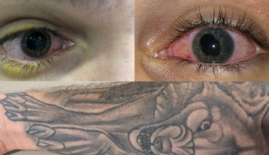 Tattoo risks: What is uveitis?