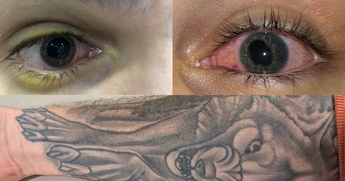 Tattoo risks: What is uveitis?