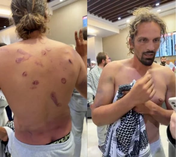 A shirtless man stands with bruises covering the top half of his back.