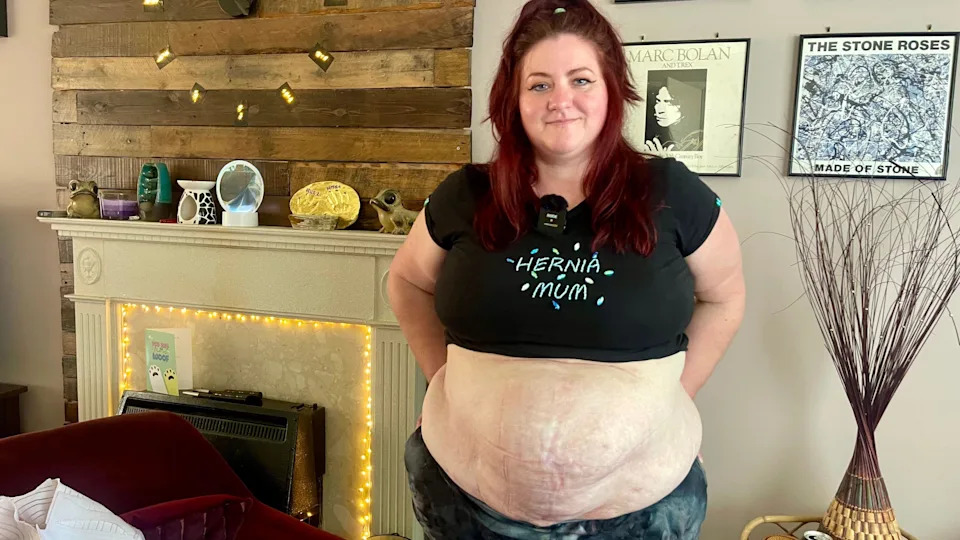 A woman with red hair has rolled up her black t-shirt to reveal a large hernia on her stomach. She is wearing dark leggings and her dark top has the words "HERNIA MUM" embroidered on it. There is a fireplace in the background, a red chair, a plant and framed records on the wall.