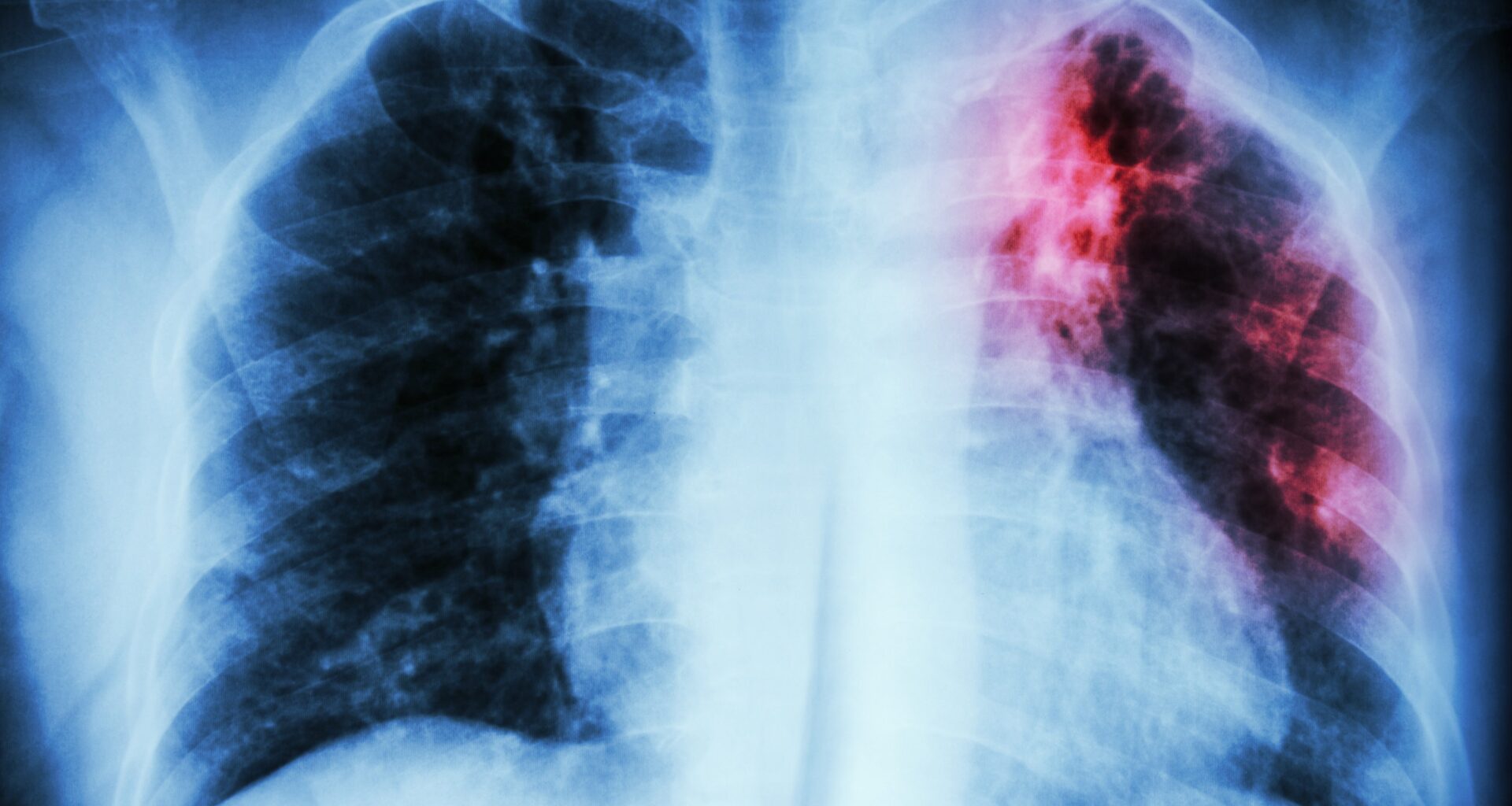 Montreal public health sets up squad to curb spike in tuberculosis cases