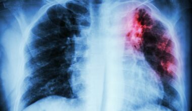 Montreal public health sets up squad to curb spike in tuberculosis cases