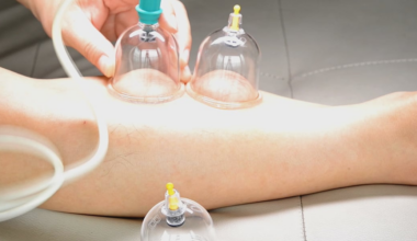 What exactly is cupping therapy?
