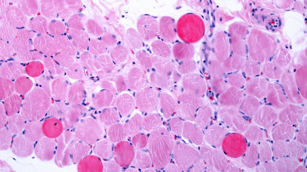 Capricor Therapeutics accuses Nippon Shinyaku of slow-walking Duchenne drug