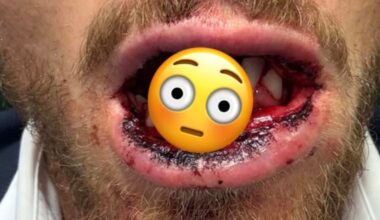 BKFC Headliner Suffers Grisly Broken Jaw Injury