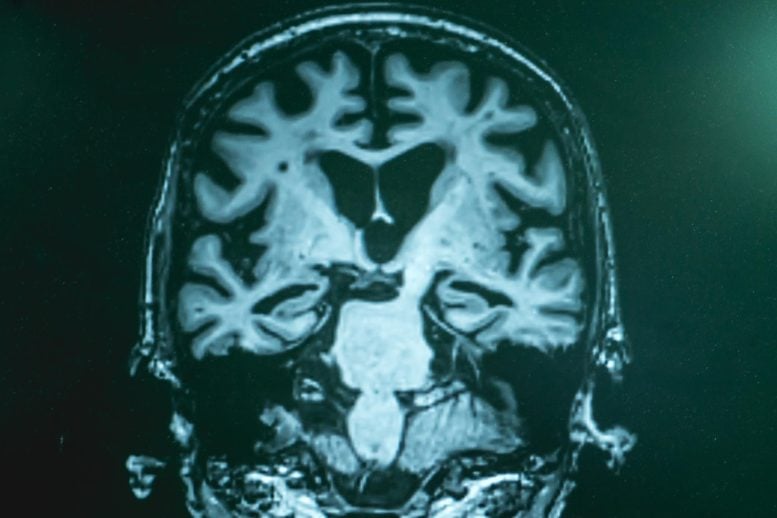 MRI Brain Scan Alzheimers Dementia Close