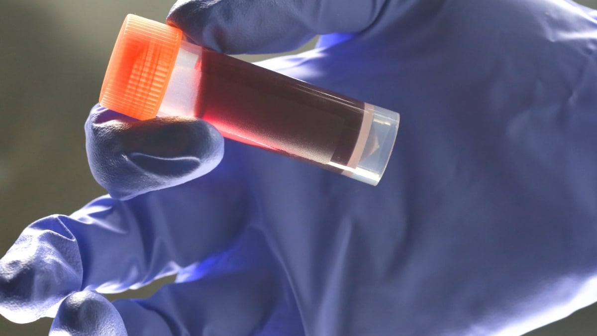 Your Blood Type Affects Risk of Early Stroke, Study Reveals : ScienceAlert
