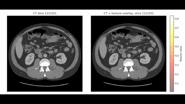 Pancreas CT scan