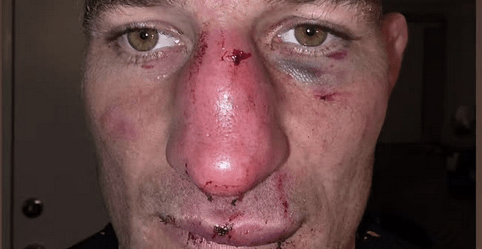 Pic: Sean Strickland shows off gruesome broken nose