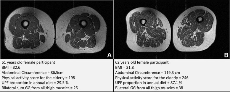 Thigh MRI Scans in a 61 Year Old Female and a 62 Year Old Female