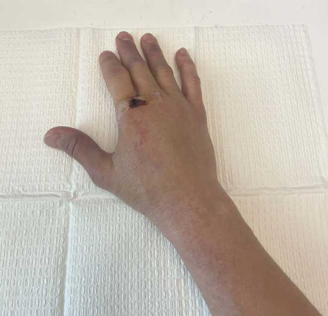Amelia Moore shows the back of her hand after getting a cast off Amelia Moore shows the back of her hand after getting a cast off