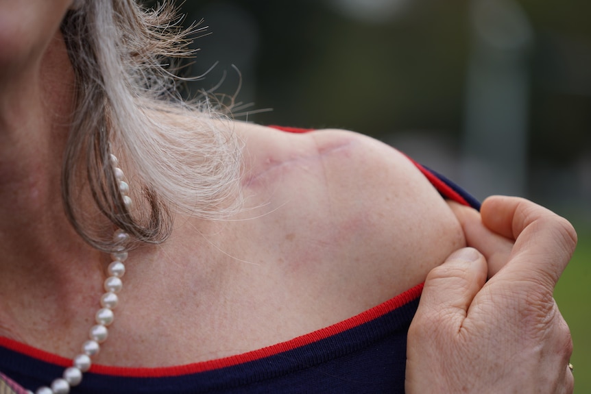 A woman pulls the top of her blouse aside, showing a 5-centimetre scar on her left shoulder