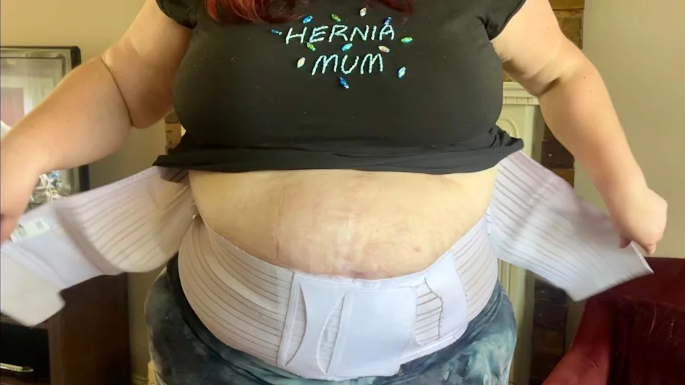 A large hernia on a woman’s stomach with a white support band partially wrapped around it.