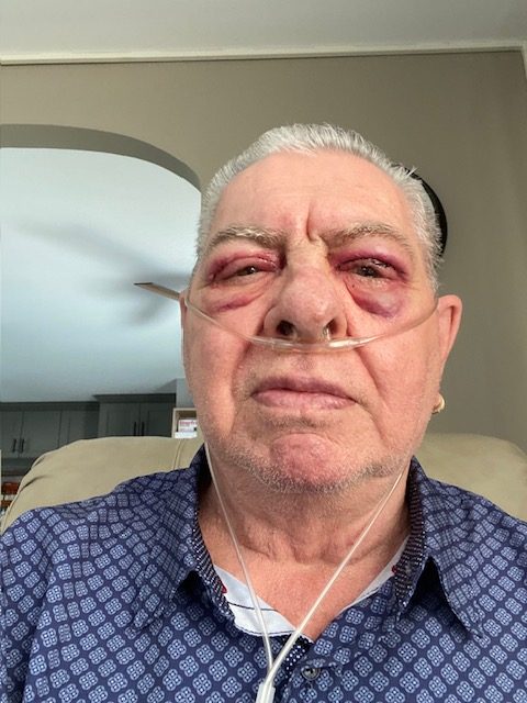 Warren Glaser is seen after eyelid surgery in a submitted photo.