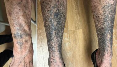 Woman's arms and legs turn blue after taking common drug