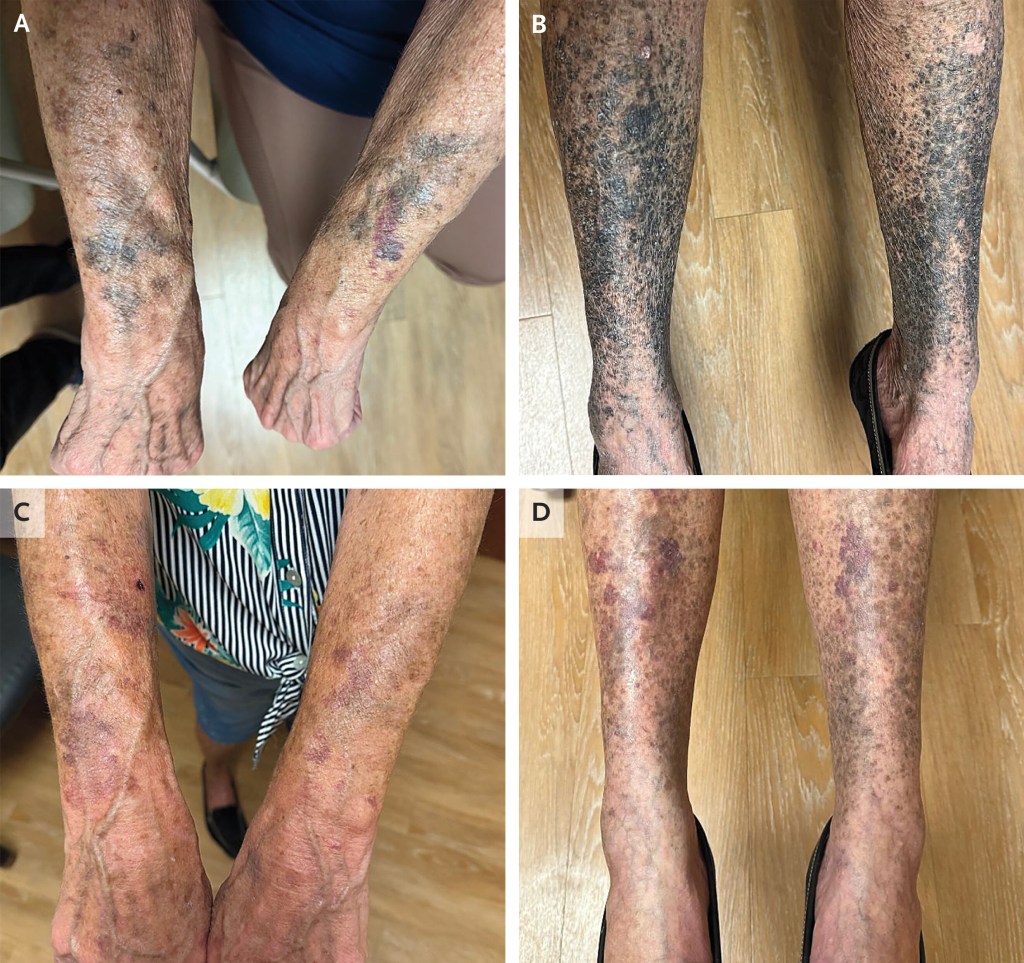 Collage of a woman's arms and legs exhibiting blue-gray discoloration due to medication.