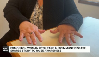 Edmonton woman living with autoimmune disease hopes to raise awareness