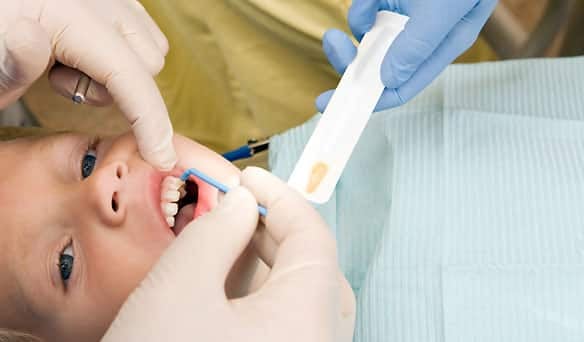 Child with mouth open as gloved hands apply something to the teeth.