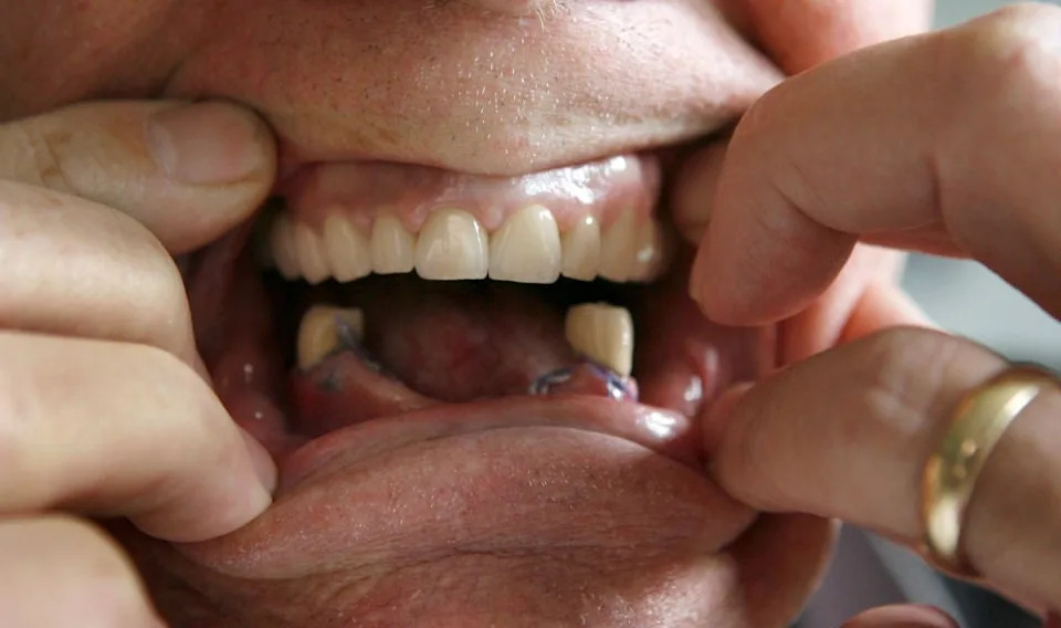 A person adjusts their lips showing their bottom and top teeth, but they are missing a lot of lower teeth