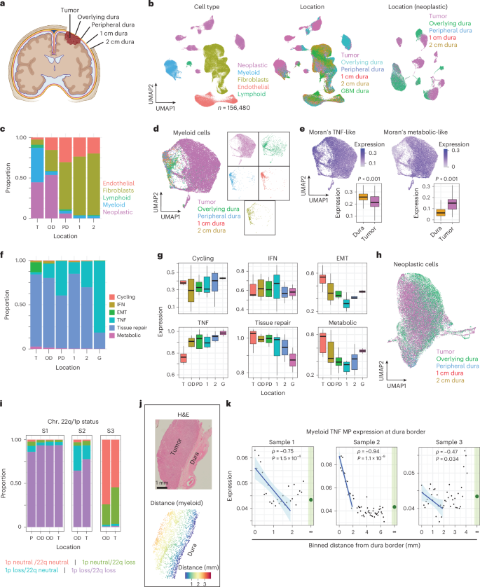 Fig. 3: Spatially resolved snRNA-seq and spatial transcriptomics reveals increased myeloid abundance and shifts in myeloid MP expression from dura to tumor.