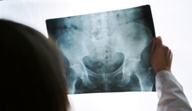 Calcium and vitamin D supplements do little to prevent falls and fractures, study suggests