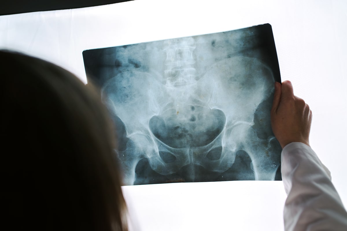 Calcium and vitamin D supplements do little to prevent falls and fractures, study suggests