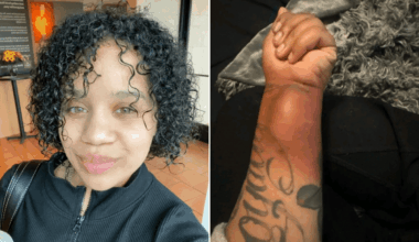 She had 28 tumors on her body, then one began to grow at an alarming rate