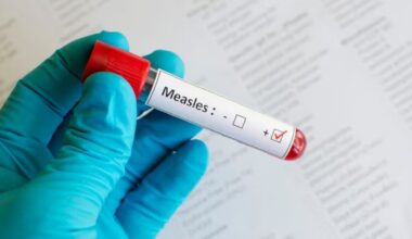 Members of the public may have been exposed to the measles at Pearson Airport, on 2 flights: health unit - CTV News