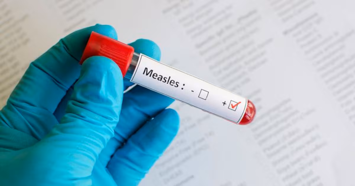 Members of the public may have been exposed to the measles at Pearson Airport, on 2 flights: health unit - CTV News