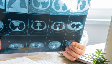 AI is helping identify heart health risks for people with breast cancer