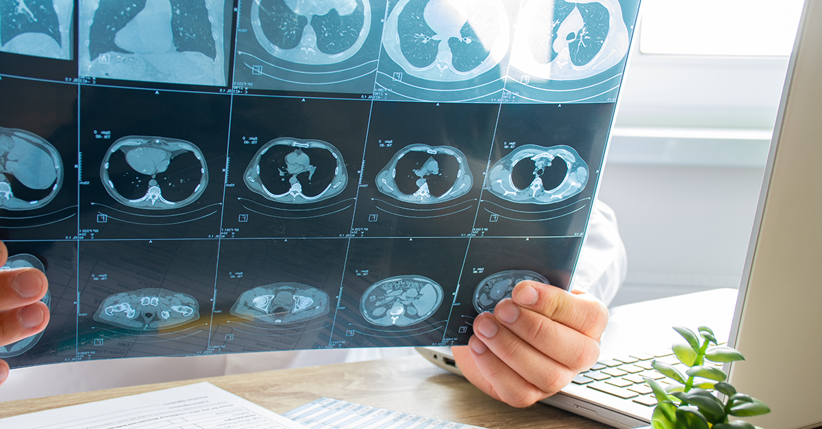 AI is helping identify heart health risks for people with breast cancer