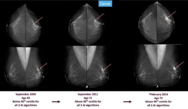Signs of Breast Cancer Could Be Spotted 3-6 Years Before Diagnosis Using AI Screening, Shows Massive Study