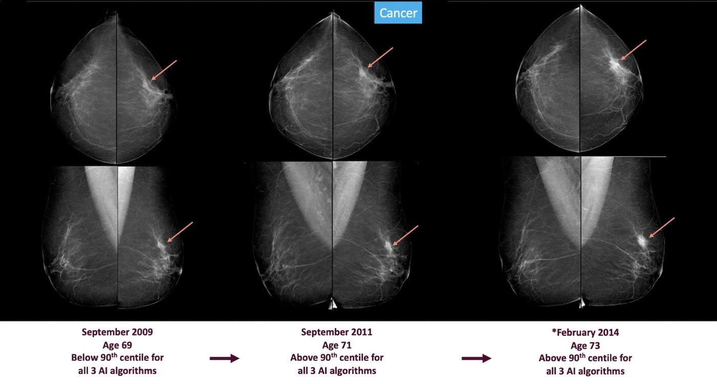 Signs of Breast Cancer Could Be Spotted 3-6 Years Before Diagnosis Using AI Screening, Shows Massive Study