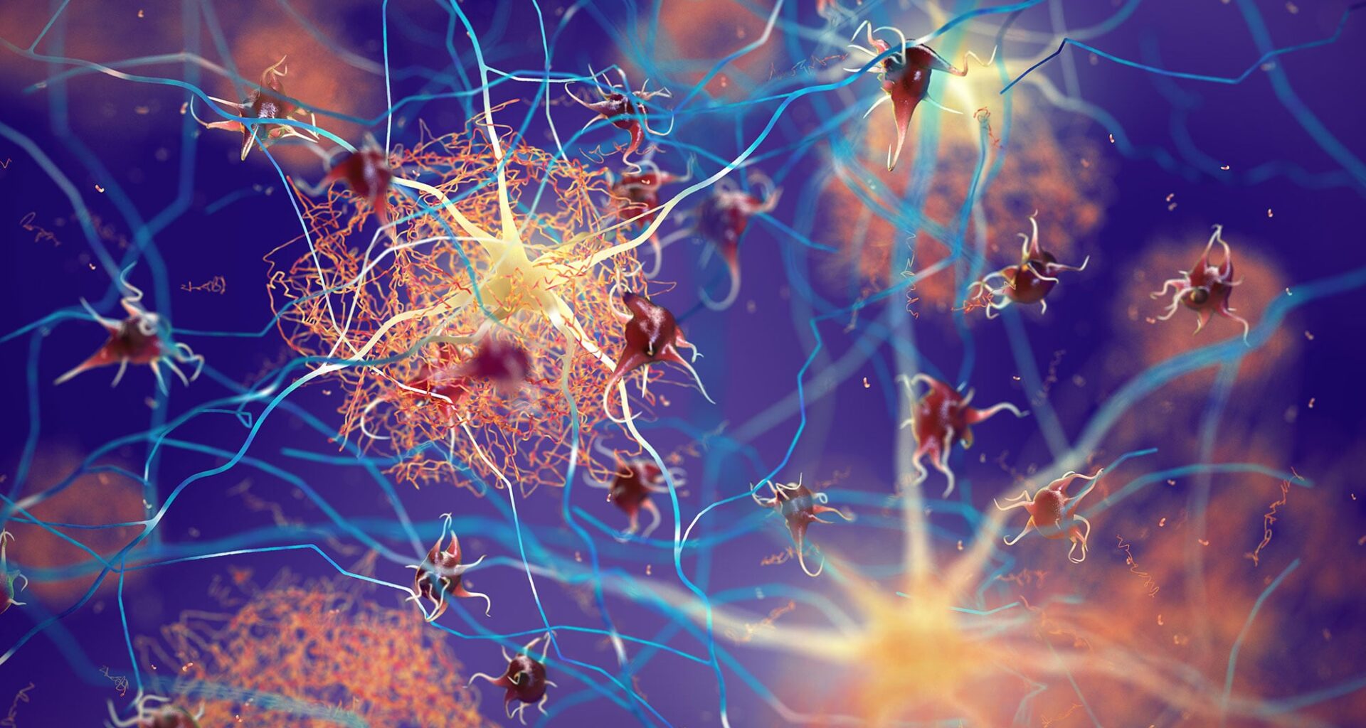 Amyloid Plaques Neurons Alzheimer