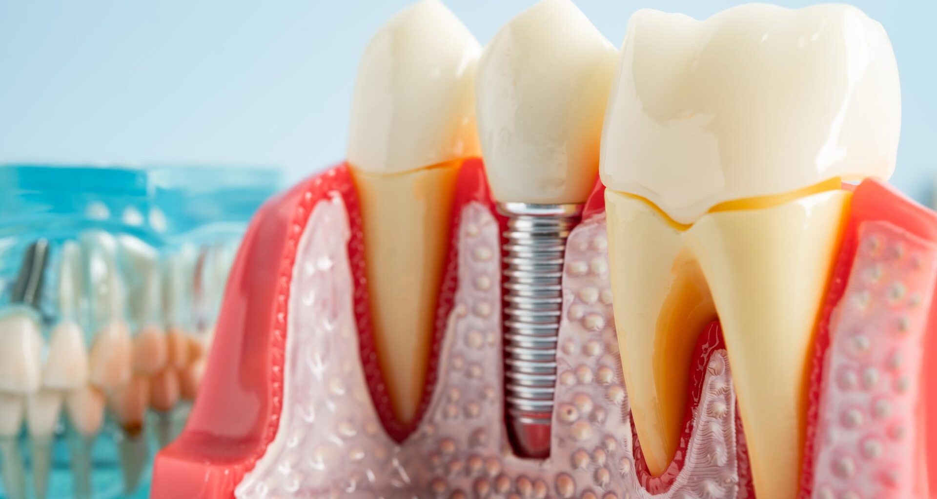 Dental Tooth Implant