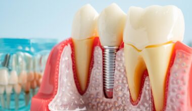 Dental Tooth Implant