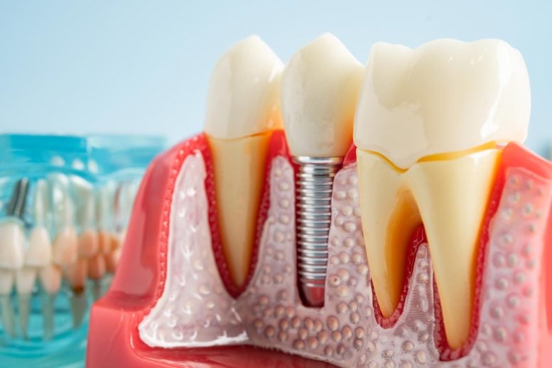 Dental Tooth Implant
