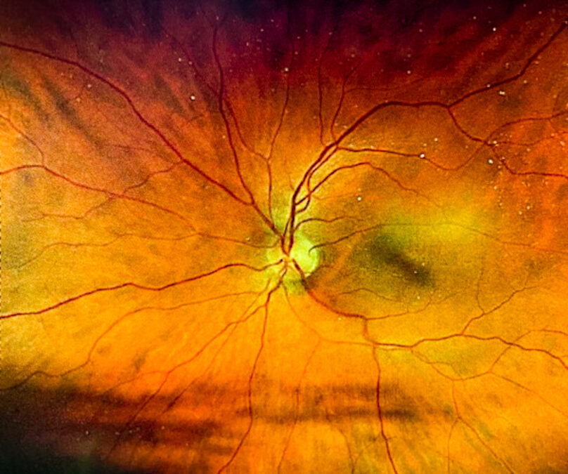 Photos of The Retina Could Reveal Important Alzheimer's Risks