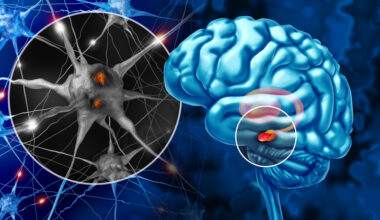Substantia Nigra And Parkinson's image, mutations in DHDDS gene can cause a rare form of the condition