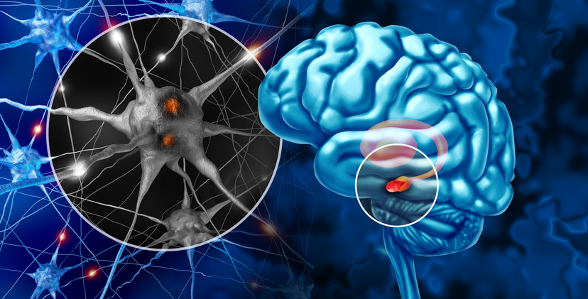 Substantia Nigra And Parkinson's image, mutations in DHDDS gene can cause a rare form of the condition