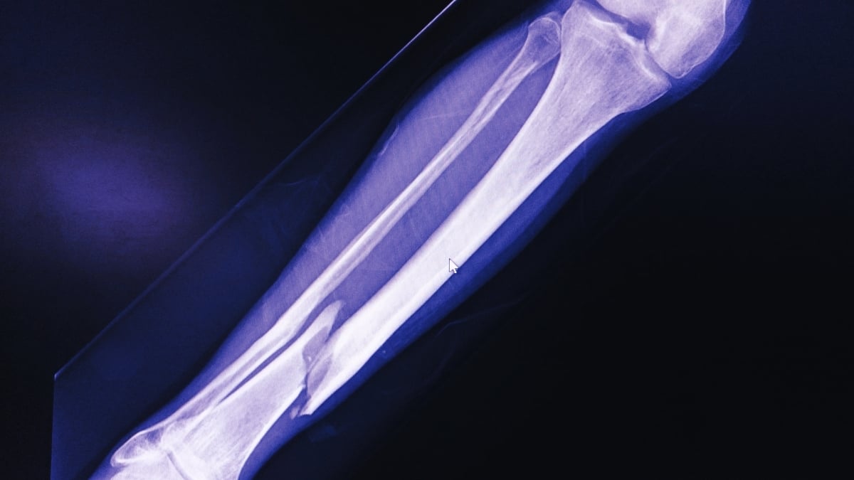 E-Bikes Are Linked to a Disturbing New Injury Phenomenon, Experts Warn : ScienceAlert