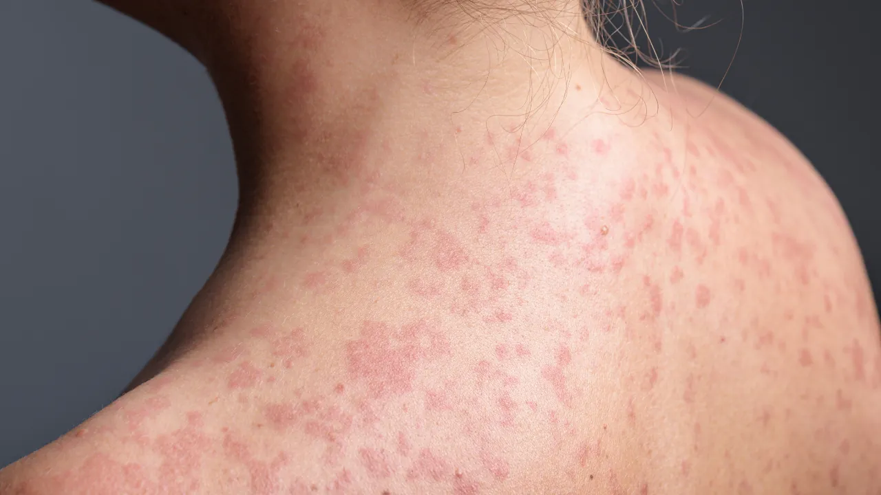 A close-up shows a red measles rash across a person’s neck and shoulder