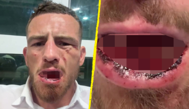 Bare-knuckle boxer retires after suffering gruesome injury in KO loss on Conor McGregor's BKFC