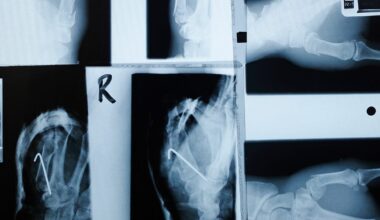 Type 2 diabetes: Semaglutide may help protect bone health