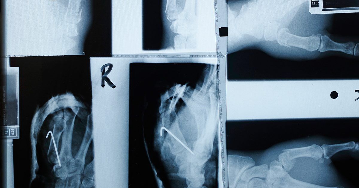 Type 2 diabetes: Semaglutide may help protect bone health